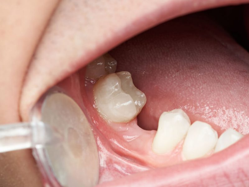 Diş Eksikliği Tedavisi